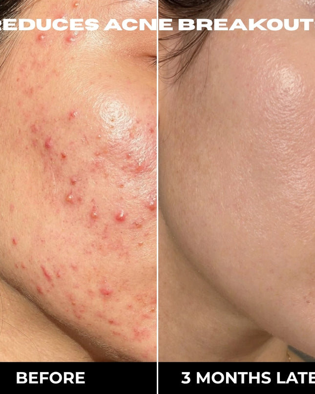 COMPLETE 6 STEP CLEAR SKIN + ANTI ACNE SET