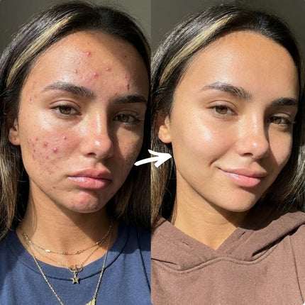 COMPLETE 6 STEP CLEAR SKIN + ANTI ACNE SET