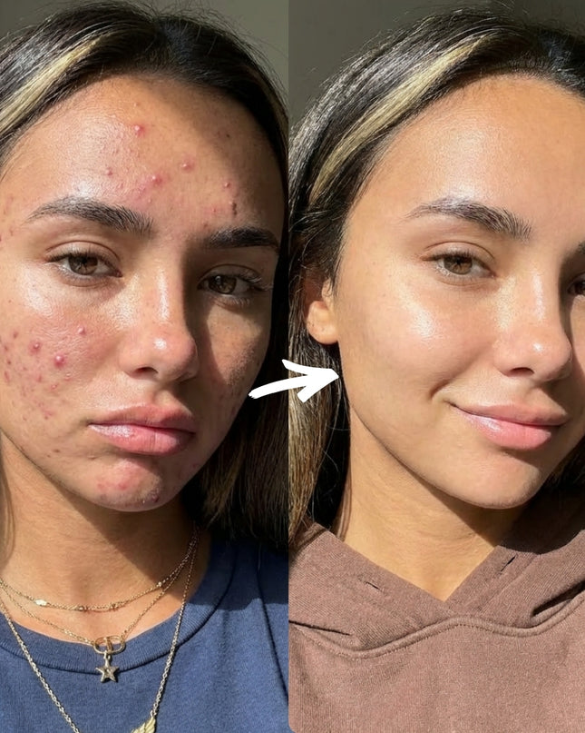 COMPLETE 6 STEP CLEAR SKIN + ANTI ACNE SET
