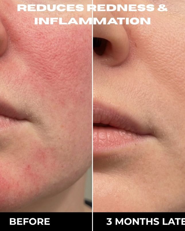 COMPLETE 6 STEP CLEAR SKIN + ANTI ACNE SET