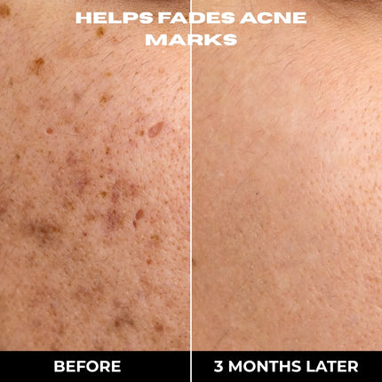 COMPLETE 6 STEP CLEAR SKIN + ANTI ACNE SET