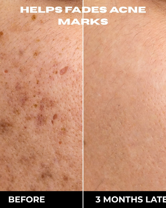 COMPLETE 6 STEP CLEAR SKIN + ANTI ACNE SET